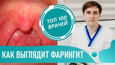 Фарингит - причины развития заболевания, симптомы, диагностика и лечение