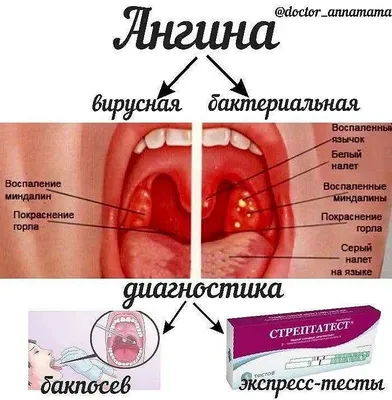 Как выглядит ФАРИНГИТ (фото). Симптомы фарингита. Острый и хронический  фарингит у детей и взрослых - YouTube