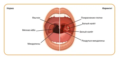 Фарингит лечение симптомы, как лечить фарингит - блог Furasol®