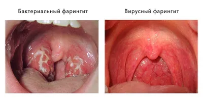 Фарингит – причины, симптомы, диагностика и способы лечения заболевания |  Клиника Будь Здоров