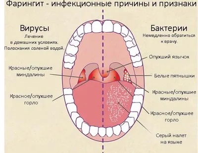 Фарингит: симптомы и лечение болезни, характерные признаки воспаления  горла, течение фарингита и профилактика