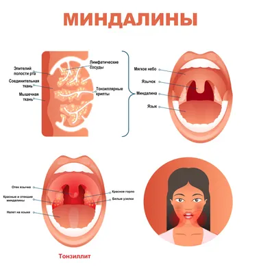 Фарингит - симптомы, причины, диагностика, и лечение в МЦ Экомед