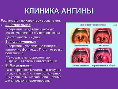 Фарингит: признаки, симптомы, лечение - МедКом