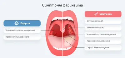 Фарингит у детей: лечение, симптомы - температура и кашель при фарингите у  ребенка | Имудон®