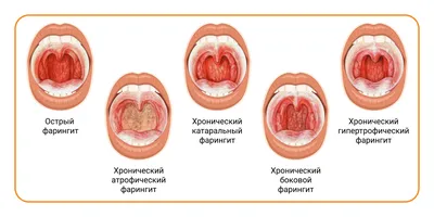 Что такое фарингит. Вирусный и бактериальный фарингит