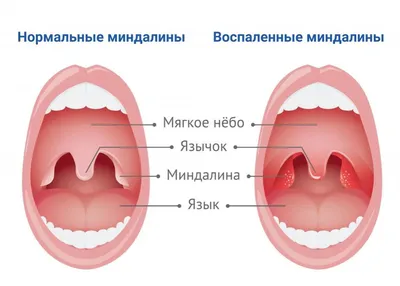 Медцентр \"МедЛайн\" - Фарингит Фарингит — это воспаление слизистой оболочки  и лимфоидной ткани глотки. Общие сведения Глотка (лат. pharynx) - это  верхняя часть желудочно-кишечного тракта человека, расположенная между  ротовой полостью и пищеводом.