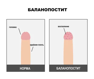 Баланопостит - симптомы острой и хронической форм, стадии и признаки у  мужчин и женщин, причины появления, диагностика и лечение заболевания