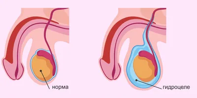 Причины боли мужского полового члена | Терапия с Росиной | Дзен