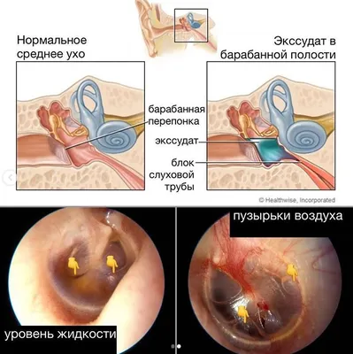 Средний отит