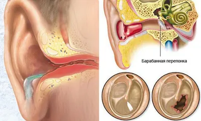 Перфорация барабанной перепонки