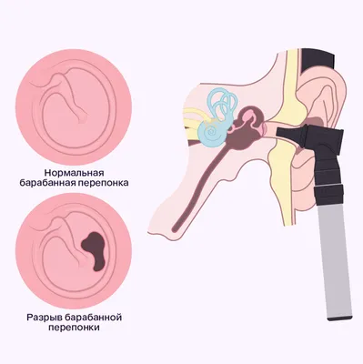 Повреждения барабанной перепонки - признаки, причины, симптомы, лечение и  профилактика - iDoctor.kz