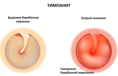 Тимпанит, или отит среднего уха