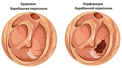 Травма барабанной перепонки – Северная панорама