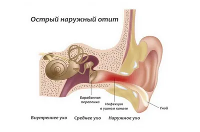 Острый средний отит у ребенка: лечение, симптомы, осложнения при воспалении  среднего уха