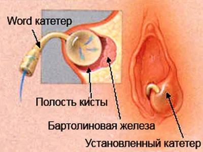 Лечение бартолинита в Киеве | Цена операции по удалению кисты