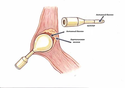 Бартолинит: причины, симптомы, диагностика, лечение | Многопрофильный  медицинский центр Воронеж
