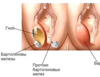 Клиника МедЭксперт - Киста бартолиновой железы – образование, возникшее  вследствие закупоривания выводящего протока железы преддверия влагалища.  Это образование представляет собой плотную капсулу, внутри которой  содержится густая секреторная жидкость ...