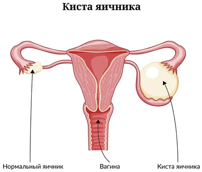 Лечение кисты бартолиновой железы