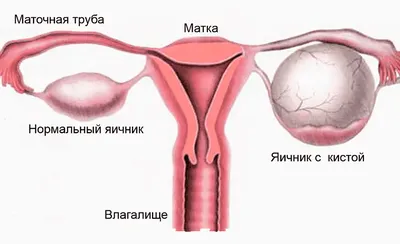 Киста яичника ♻️️ Удаление кисты яичника, операция | Мед Сити