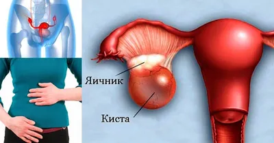 Удаление кисты влагалища и бартолиниевой железы в клинике \"АБИА\"