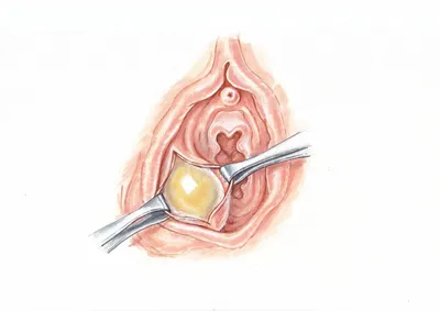 Киста бартолиновой железы... - Dr. Aynur Mukhtarova | Facebook