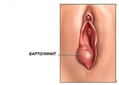 Бартолинит у женщин: ФОТО, симптомы, ЛЕЧЕНИЕ | Курортная Клиника Женского  Здоровья