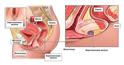 Бартолинит - причины появления, симптомы заболевания, диагностика и методы  лечения