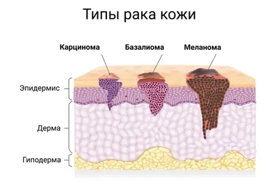 Базалиома кожи – симптомы, виды, стадии, методы лечения, стоимость лечения  в Израиле