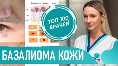 Базальноклеточный рак: склеродермоподобная форма. Случай №605 из  дерматологического атласа профессора Ю.В. Сергеева. Изображение 2144.  Клинические фото