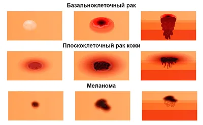 Онко Вики — Формы базалиомы