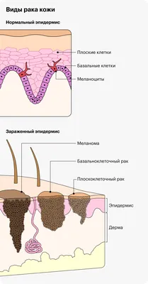 Случай №42. Плоскоклеточный рак… и, да, снова про опухоль кожи. | Сайт  дерматовенеролога Бетехтина М.С.