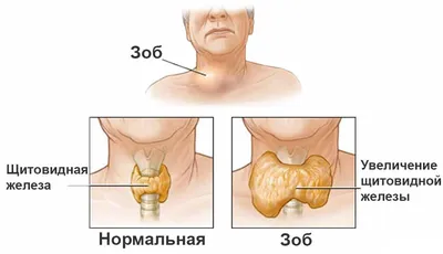 Диффузный токсический зоб (Базедова болезнь, болезнь Грейвса) -  ЭНДОКРИНОЛОГИЯ | Добро пожаловать в «Клинику Айгерим»