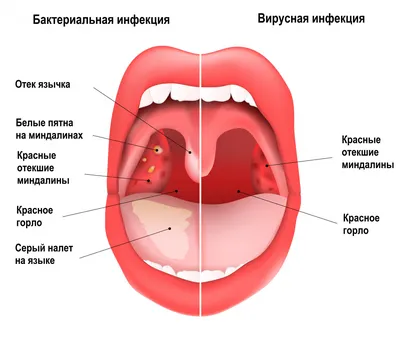 Белое пятно на горле - Вопрос лору - 03 Онлайн