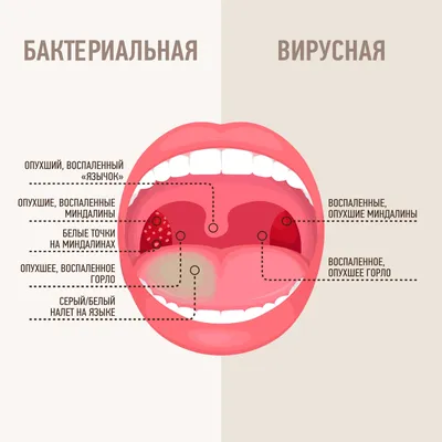 Странные ощущения в горле и белые пятна - Вопрос лору - 03 Онлайн