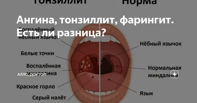 Тонзиллит острый и хронический: лечение тонзиллита у взрослого и ребенка