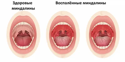 Гланды, аденоиды, миндалины у ребенка и взрослого: в чем разница, где  находятся, симптомы и лечение