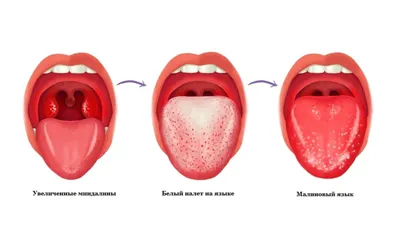 Тонзиллит (ангина) | ВКонтакте