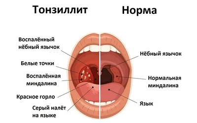 Белые точки на гландах у детей: симптомы и причины появления. Лечение  тонзиллита — Статьи — ОН КЛИНИК Бейби