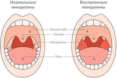 Ангина, тонзиллит, фарингит. Есть ли разница? | Алло, доктор! | Дзен