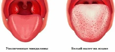 Тонзиллит - причины появления, симптомы заболевания, диагностика и способы  лечения