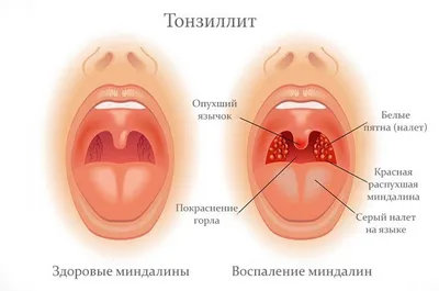 Тонзиллит | Симптомы | Диагностика | Лечение - Lik.ua