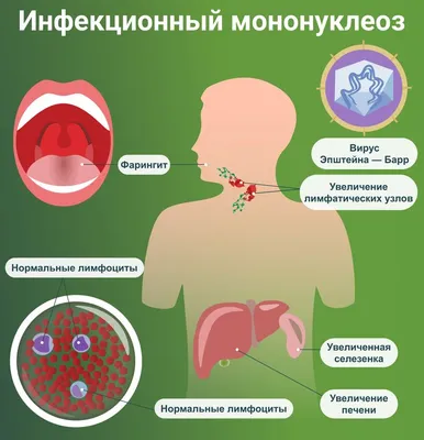 Ангина у детей и взрослых: причины, симптомы, диагностика и лечение: Уход  за собой: Забота о себе: Lenta.ru