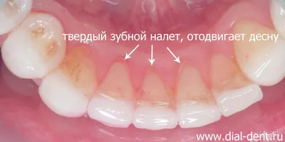 Профессиональная чистка зубов при тотальном протезировании керамикой