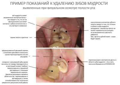 Осложнения после удаления зуба - какие могут быть, причины, симптомы,  лечение, профилактика