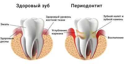 Что делать, если потемнел край коронки? Оголение корня зуба