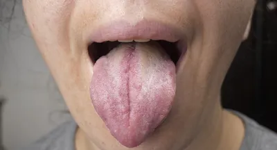 Белый налет на языке: что означает, симптомы и лечение заболевания