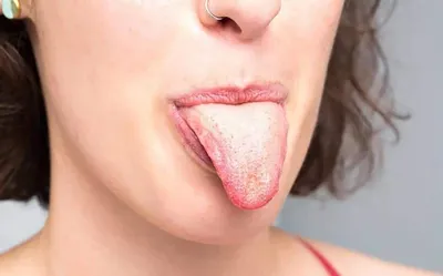 Белый налет на языке — симптом или норма? Проверьте свой язык! | ЦКБ  РЖД-Медицина | Дзен