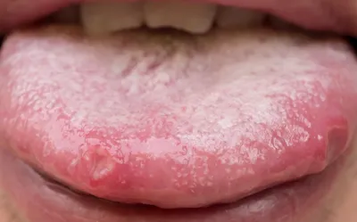 Лечение красных пятен на языке