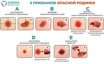 Как отличить опасные родинки от остальных?