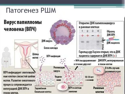 Дерматовенеролог Анатолий Андреев - Лечение Папиллом Папиллома (papilla –  сосок (лат.) + oma – опухоль (греч)) – сосочковые разрастания на коже и  слизистых оболочках. Если о герпесе лица («лихорадка», «простуда») и о